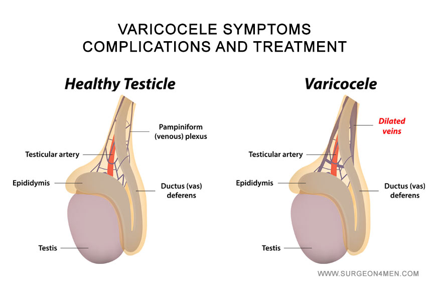 Varicocele in Children (Adolescent Varicocele): Causes, Symptoms